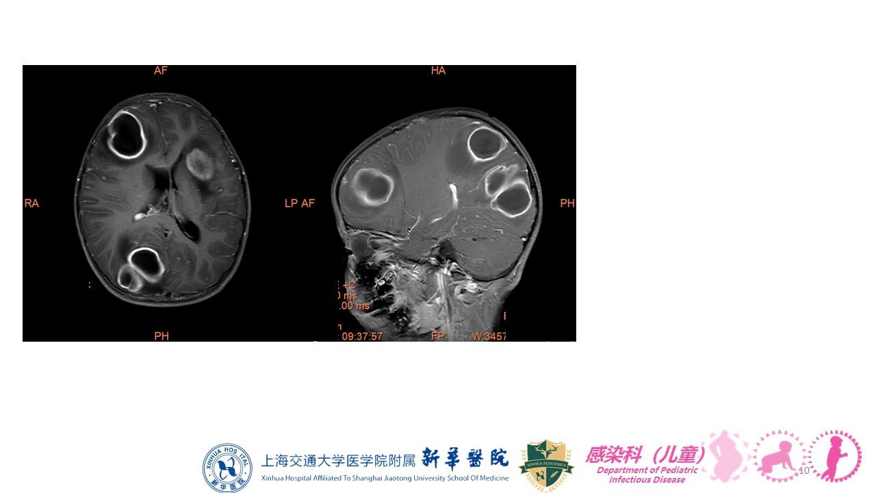 二岁儿童后脑着地跌伤后发生呕吐现象,但CT扫描脑部沒有发现不正常,但还吐,为什么「骨折以后为什么总想吐呢」 搜狗SEO 二岁儿童后脑着地跌伤后发生呕吐现象,但CT扫描脑部沒有发现不正常,但还吐,为什么「骨折以后为什么总想吐呢」 二岁儿童后脑着地跌伤后发生呕吐现象,但CT扫描脑部沒有发现不正常,但还吐,为什么「骨折以后为什么总想吐呢」 搜狗SEO